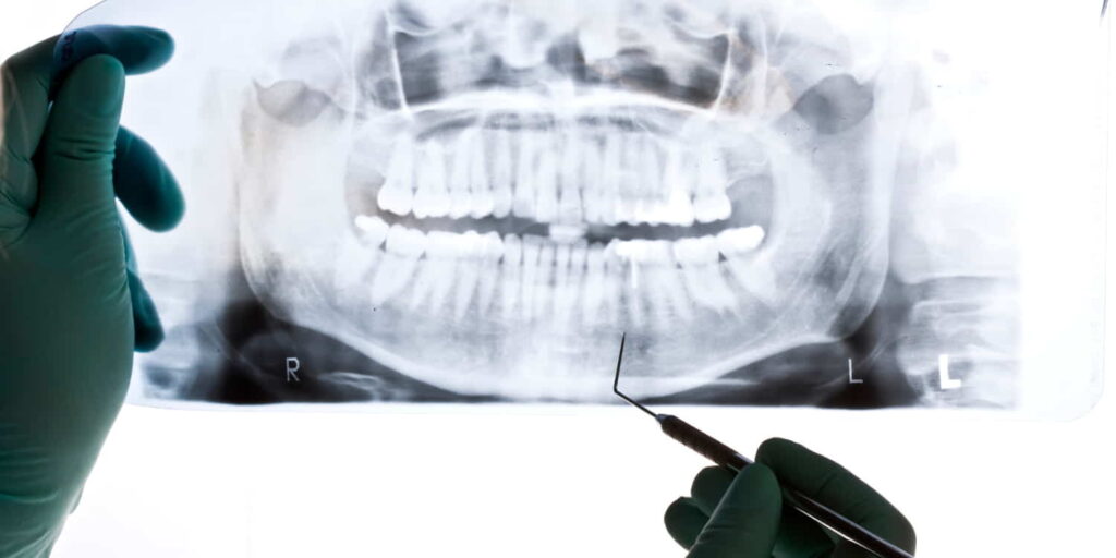 Cómo hacer una radiografía periapical