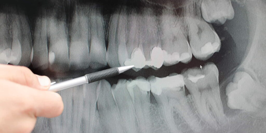 Cómo interpretar una radiografía dental